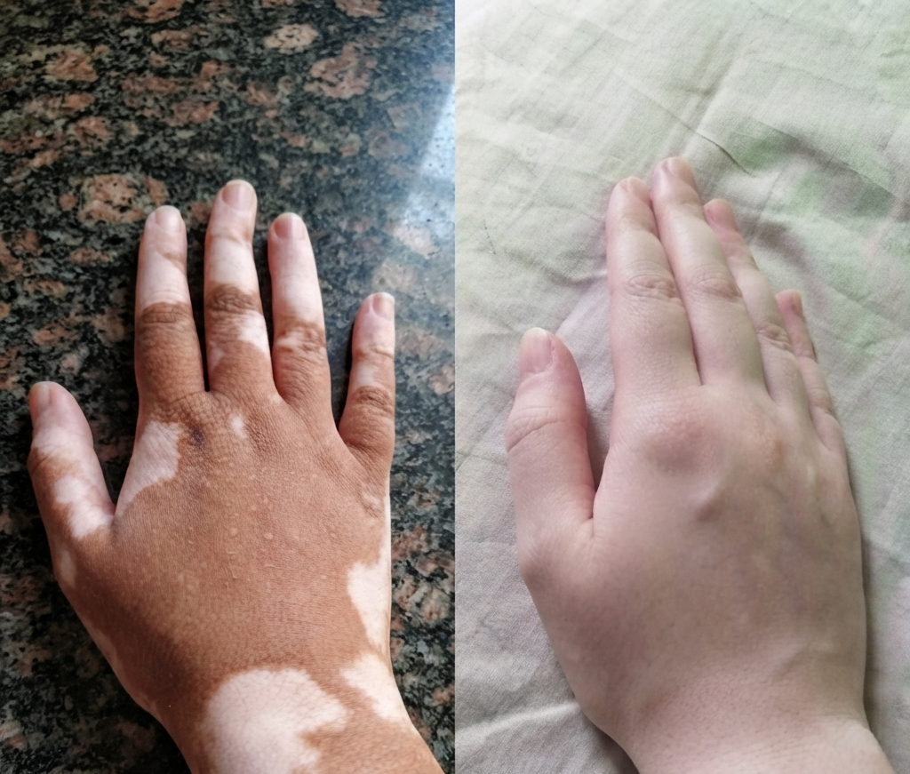 How Vitiligo Is Diagnosed