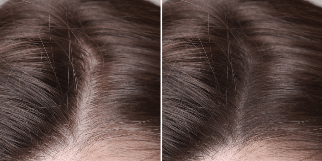 Mesotherapy Before & After: Expectations and Honest Outcomes - Cosmetics Compounding