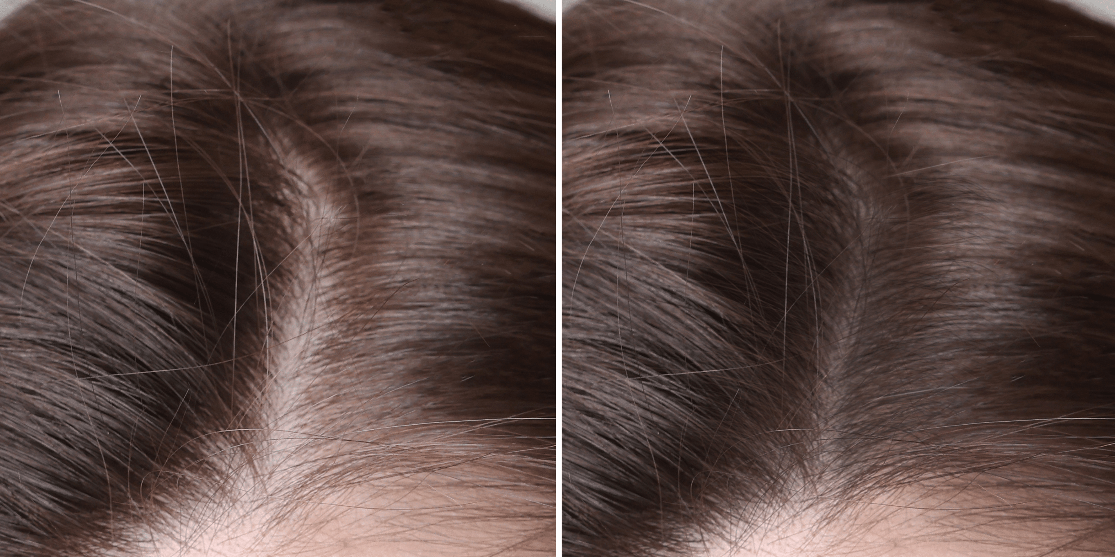 Mesotherapy Before & After: Expectations and Honest Outcomes - Cosmetics Compounding