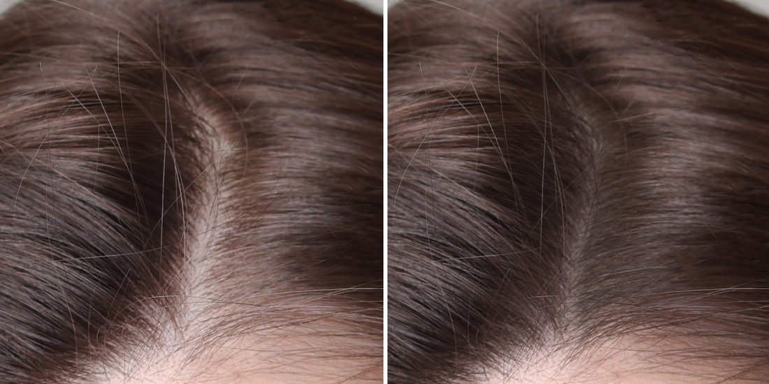 Mesotherapy Before & After: Expectations and Honest Outcomes