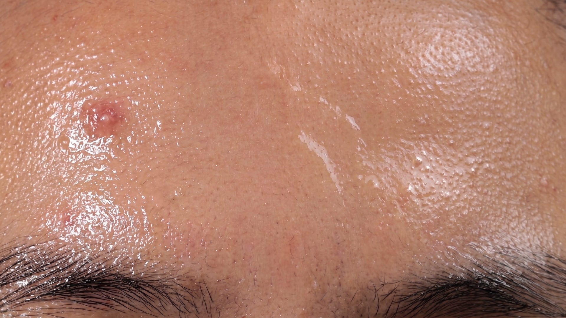 Special Considerations for Oily Skin