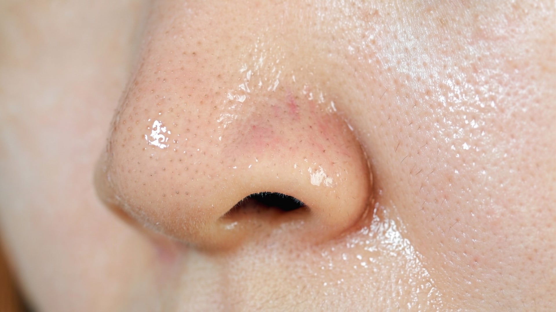 Home Remedies and Natural Treatments for Oily Skin