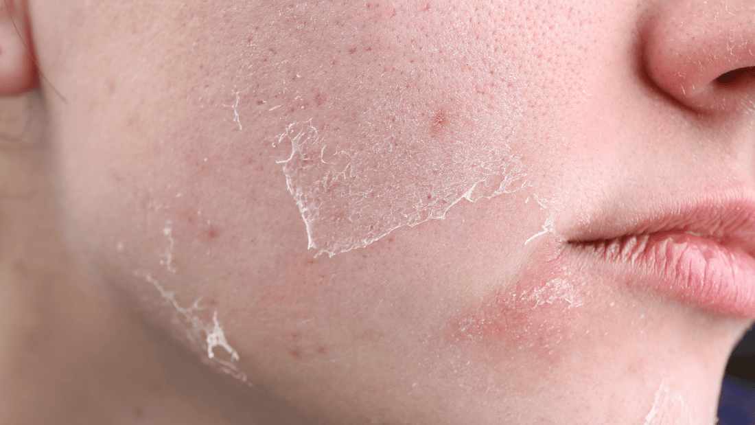 How Chemical Peels Work: The Mechanism of Chemical Peels - Cosmetics Compounding