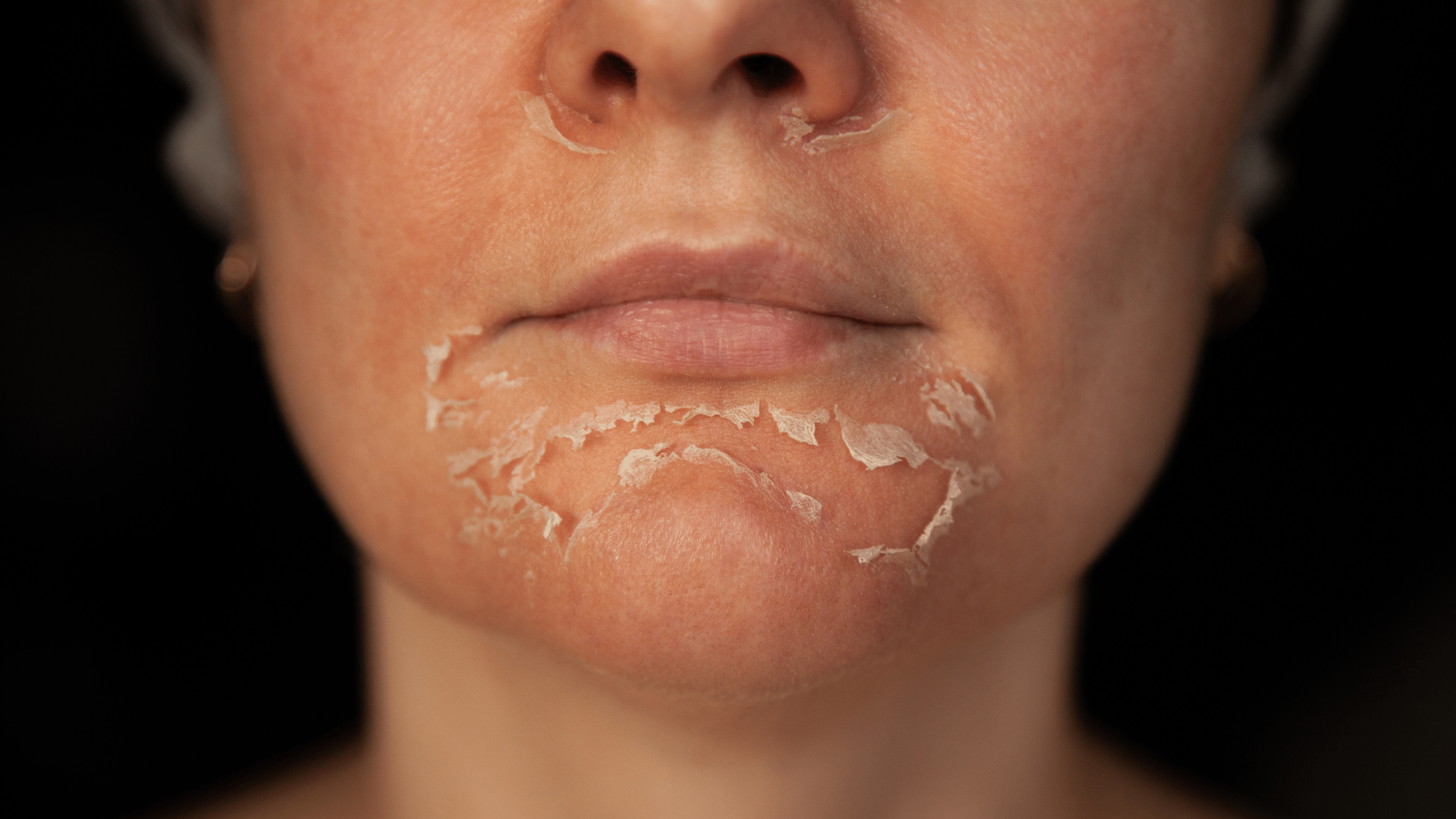 Types of Chemical Peels: Superficial, Medium & Deep Defined - Cosmetics Compounding