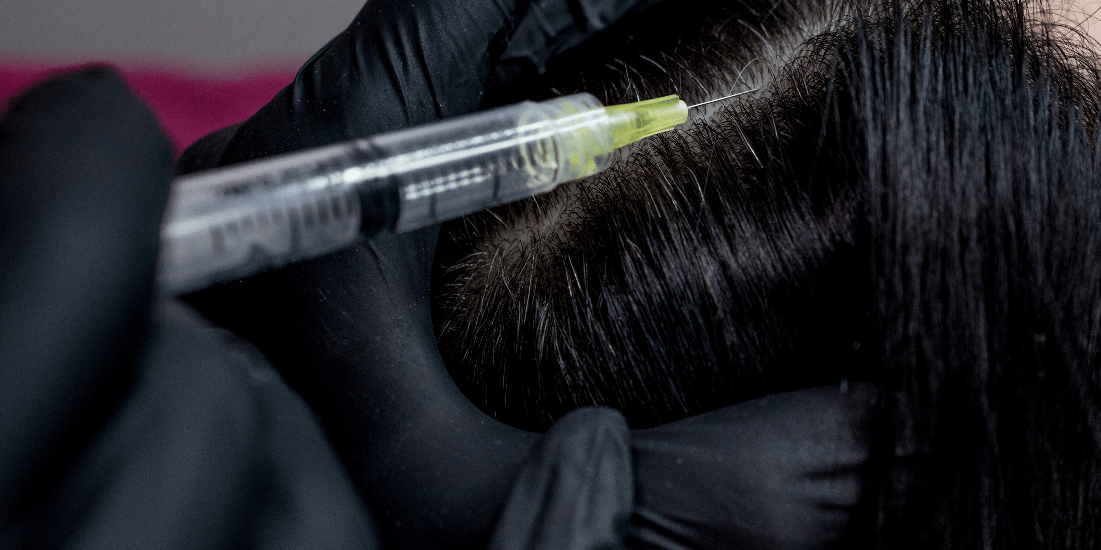 Mesotherapy in Hair Loss Management: An Established Overview - Cosmetics Compounding