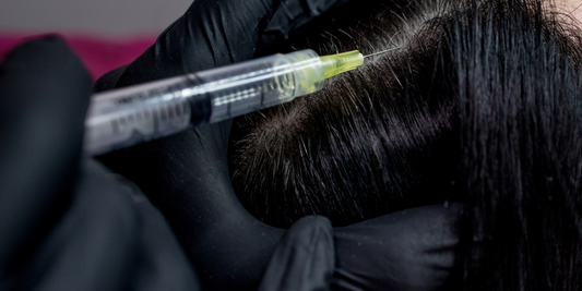 Mesotherapy in Hair Loss Management: An Established Overview