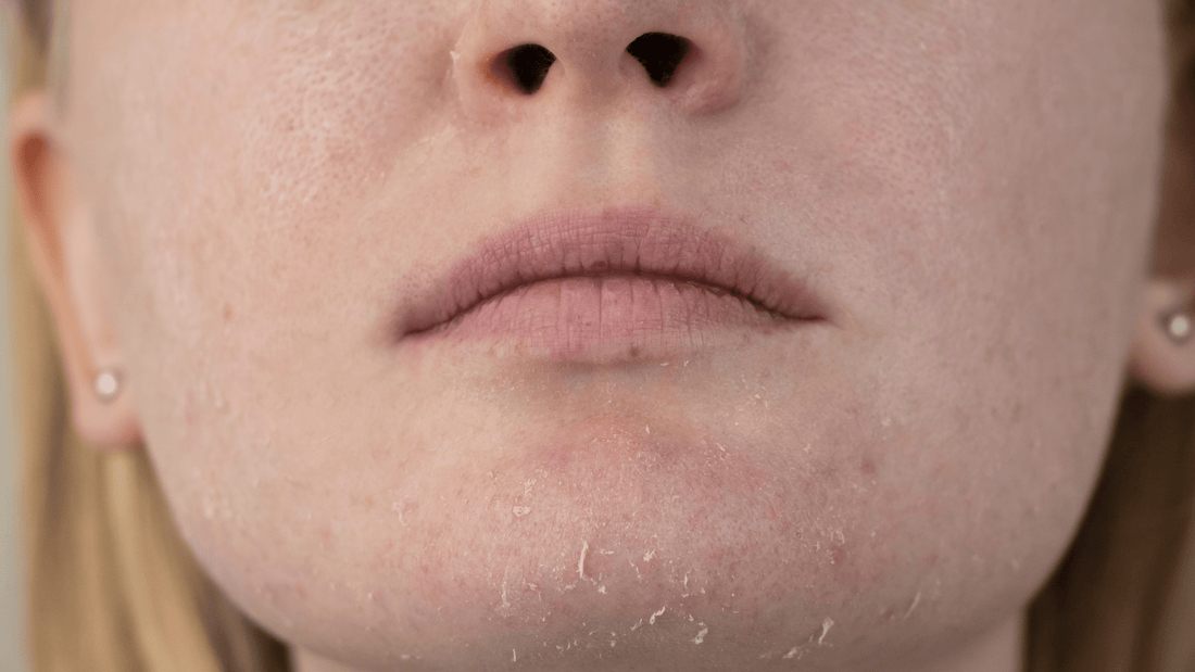 Who Should Get a Chemical Peel: The Ideal Candidates - Cosmetics Compounding