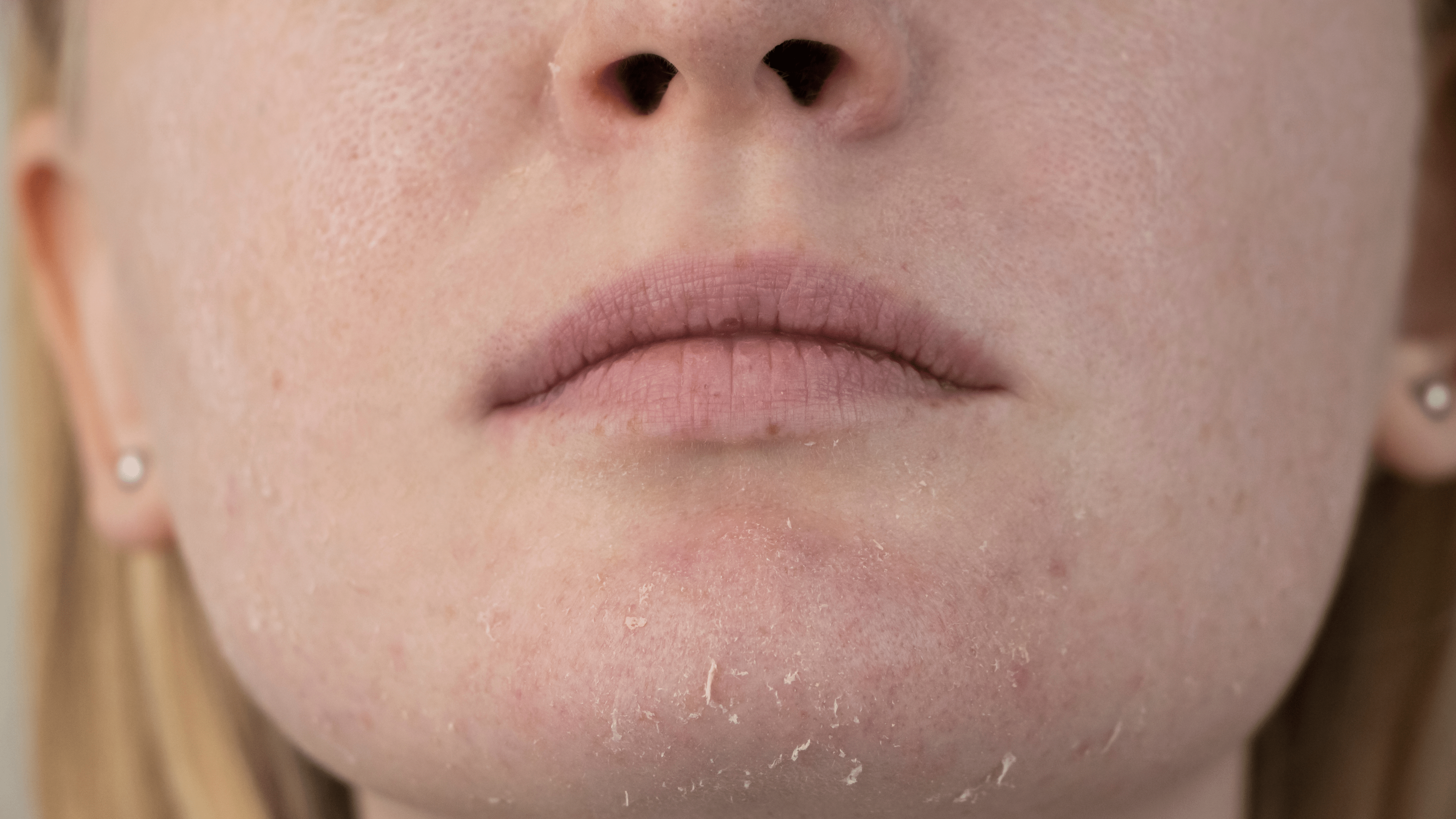 Who Should Get a Chemical Peel: The Ideal Candidates - Cosmetics Compounding