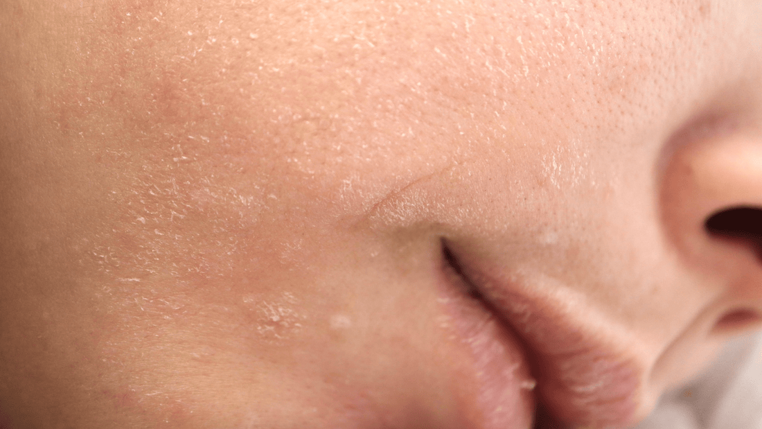 What Happens After a Chemical Peel: Care and Recovery Guide - Cosmetics Compounding