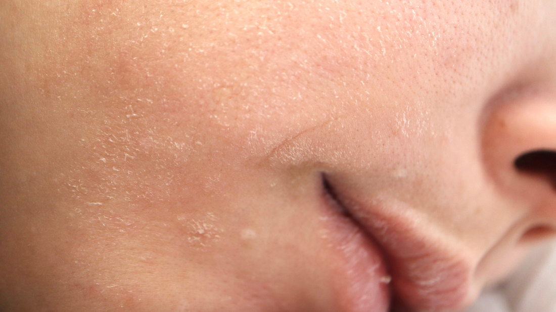 What Happens After a Chemical Peel: Care and Recovery Guide