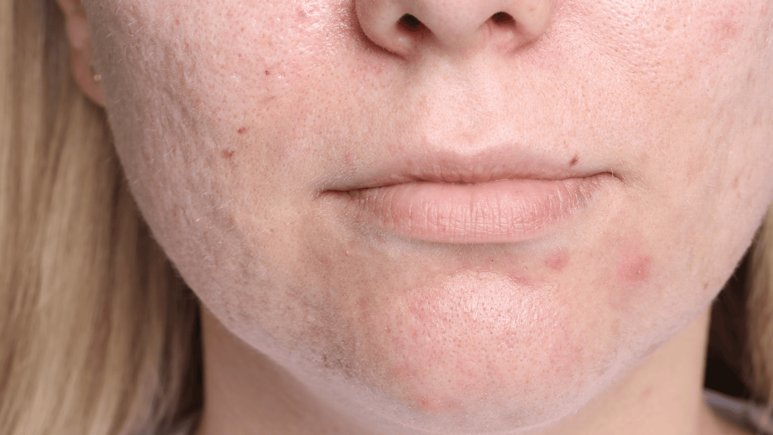 Chemical Peels for Acne, Scars, and Active Breakouts - Cosmetics Compounding