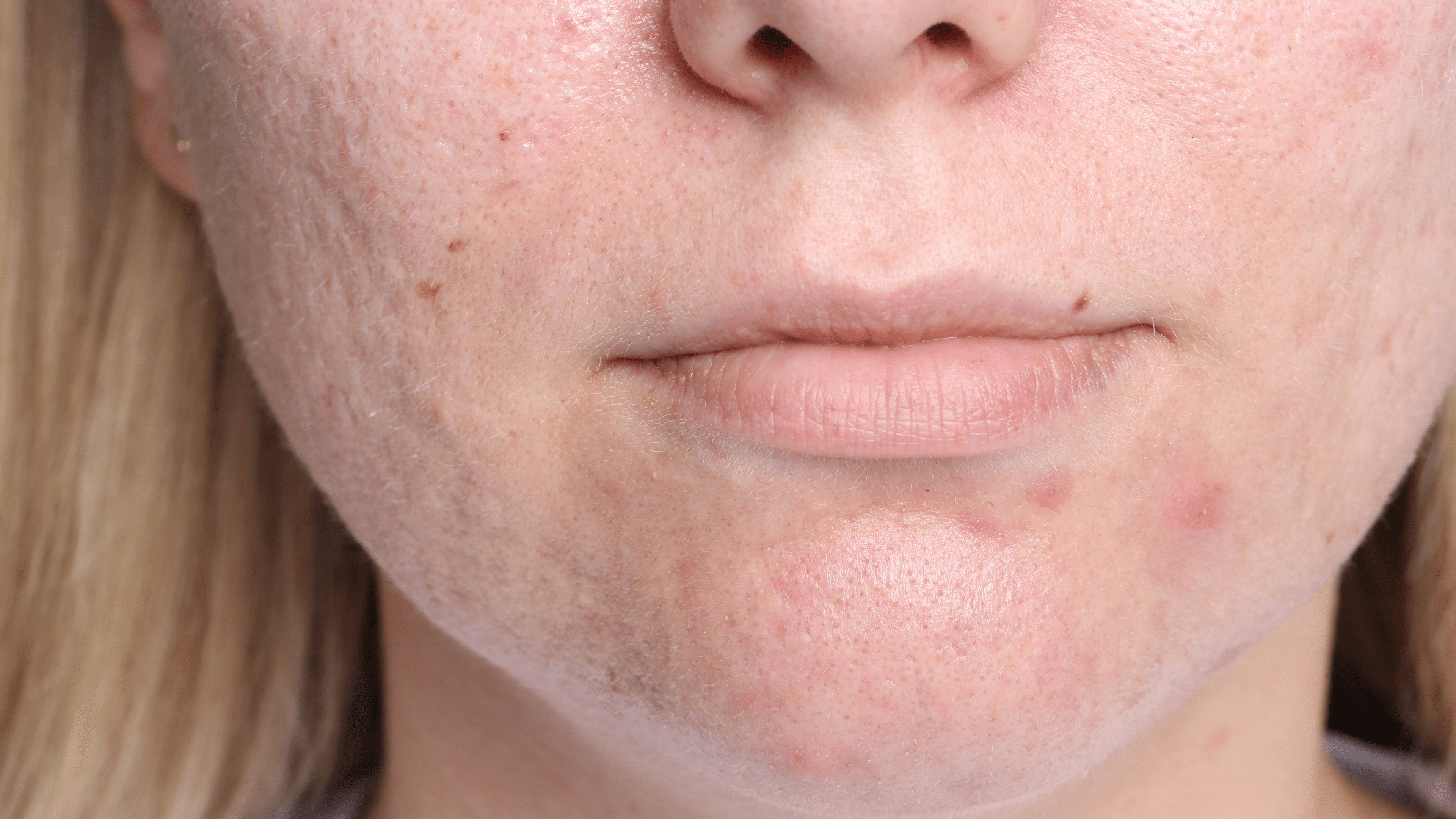Chemical Peels for Acne, Scars, and Active Breakouts - Cosmetics Compounding