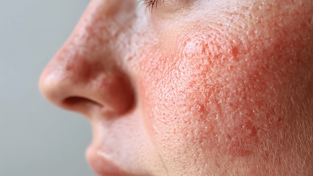 Brightening Hyperpigmented Skin with Chemical Peels - Cosmetics Compounding