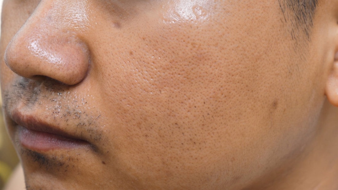 Topical Treatments, Masks, and Professional Options for Oily Skin