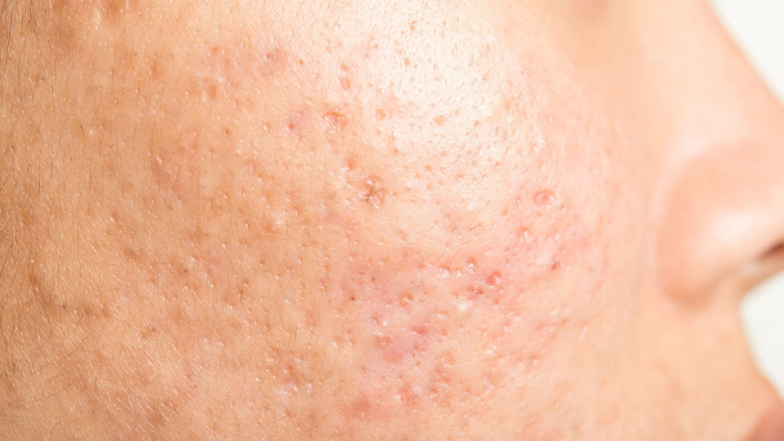 Creams, Serums, Medicines, and Peels for Scar Treatment