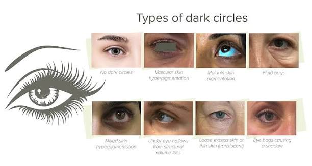 Symptoms and Types of Dark Circles