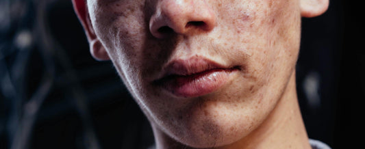 What Is Acne Pigmentation? Causes, Duration, and Solutions