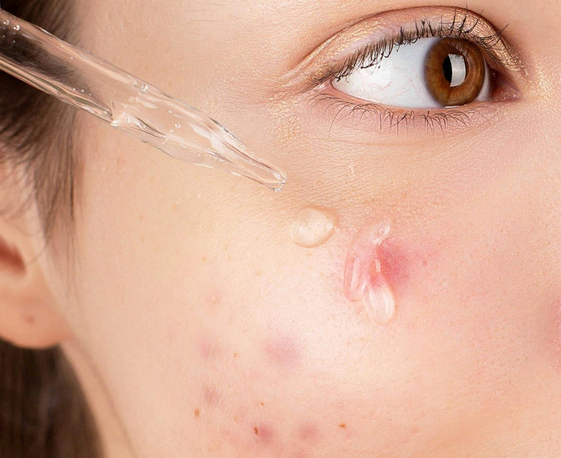 Treat Acne Permanently: Practical Methods to Clear Your Skin