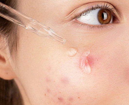 Treat Acne Permanently: Practical Methods to Clear Your Skin