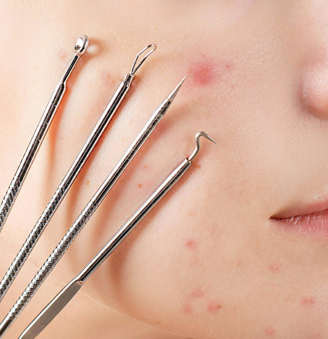 Acne Triggers Explained: Hormones, Stress, Diet, & Lifestyle
