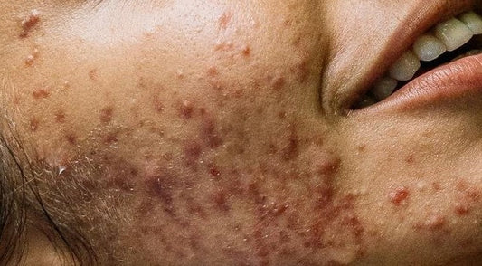 Acne Overview: The Most Common Skin Concern