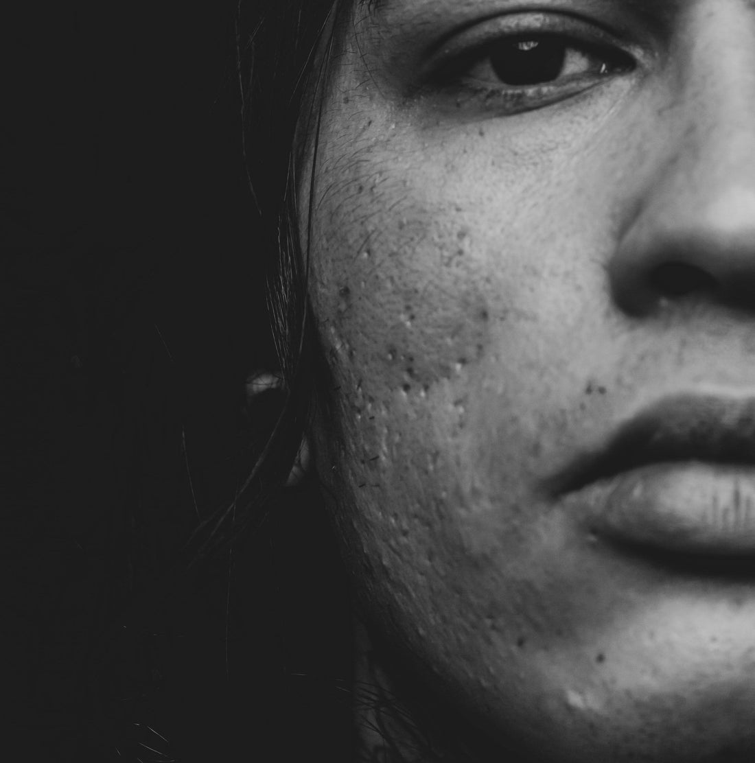 Acne Scars and Post-Acne Marks: Causes and Treatment