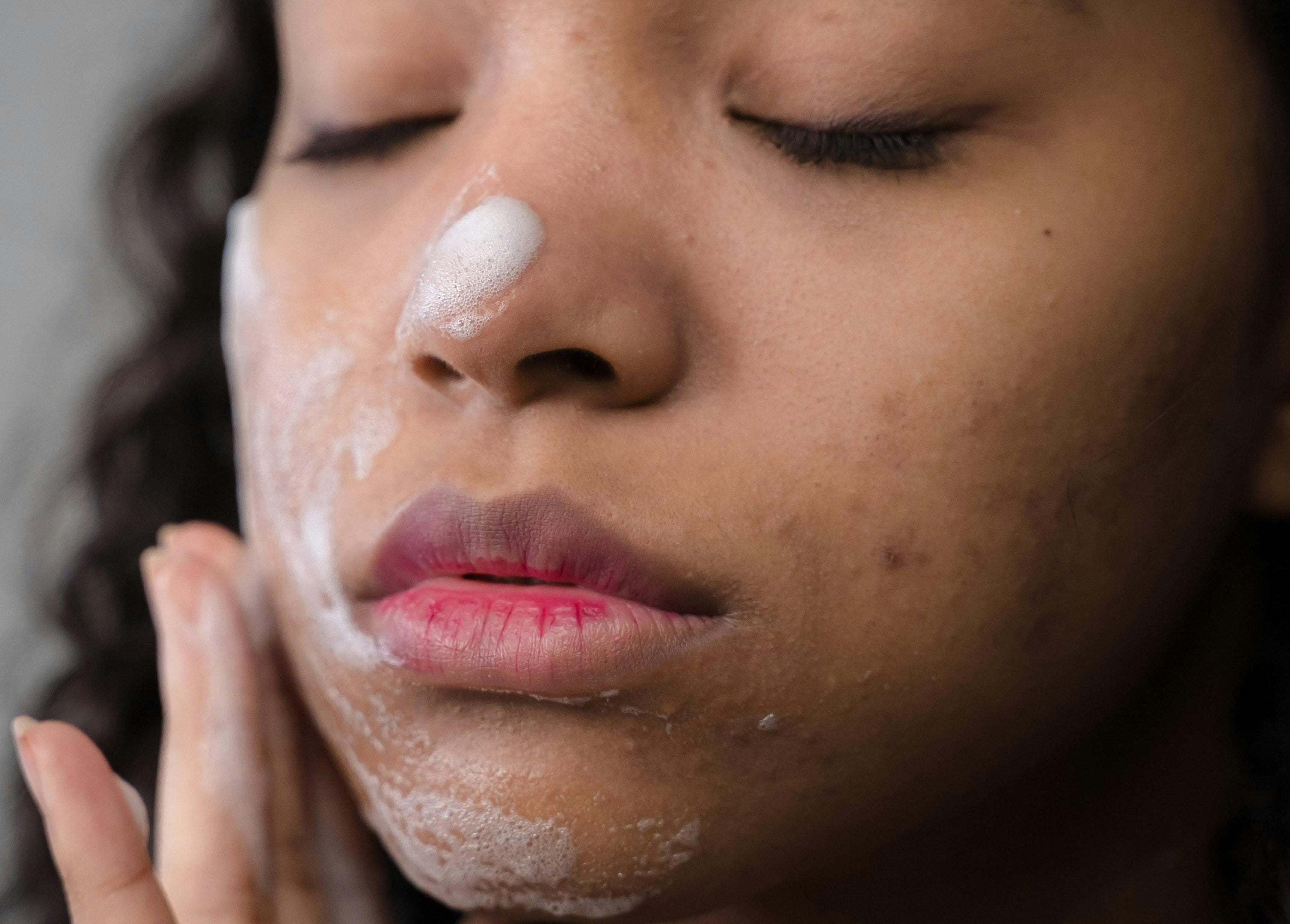 Acne Prevention and Long-Term Skin Care Strategies - Cosmetics Compounding