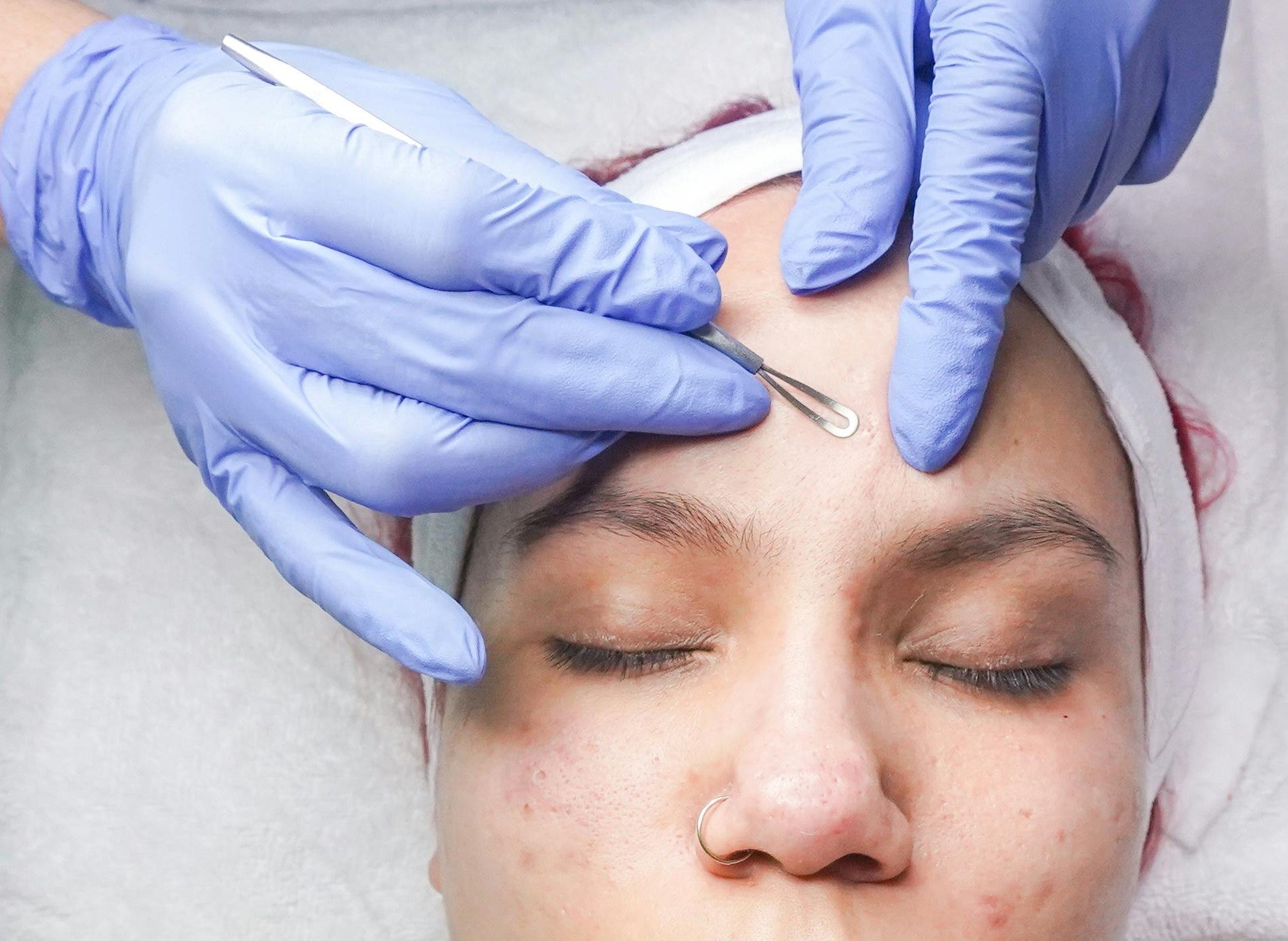 When to See a Professional: When Acne Needs Medical Care - Cosmetics Compounding