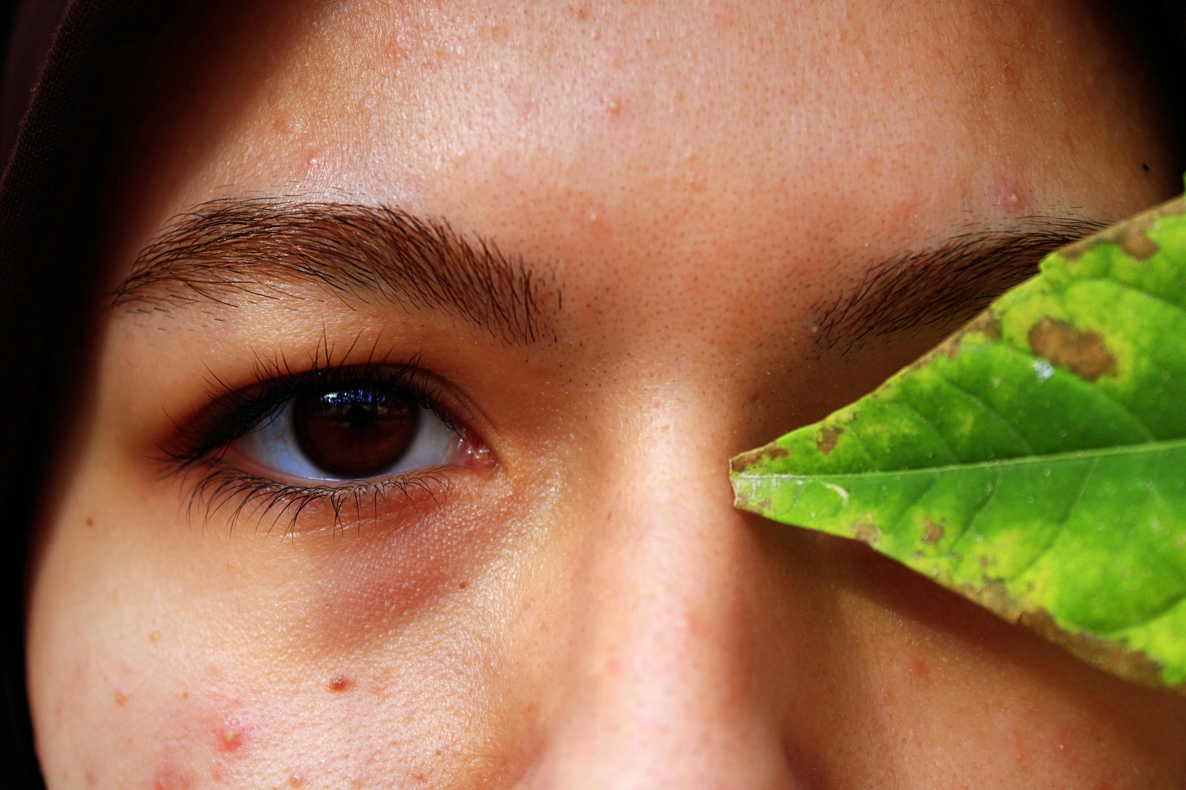 8 Common Acne Myths: Facts vs Harmful Misinformation - Cosmetics Compounding