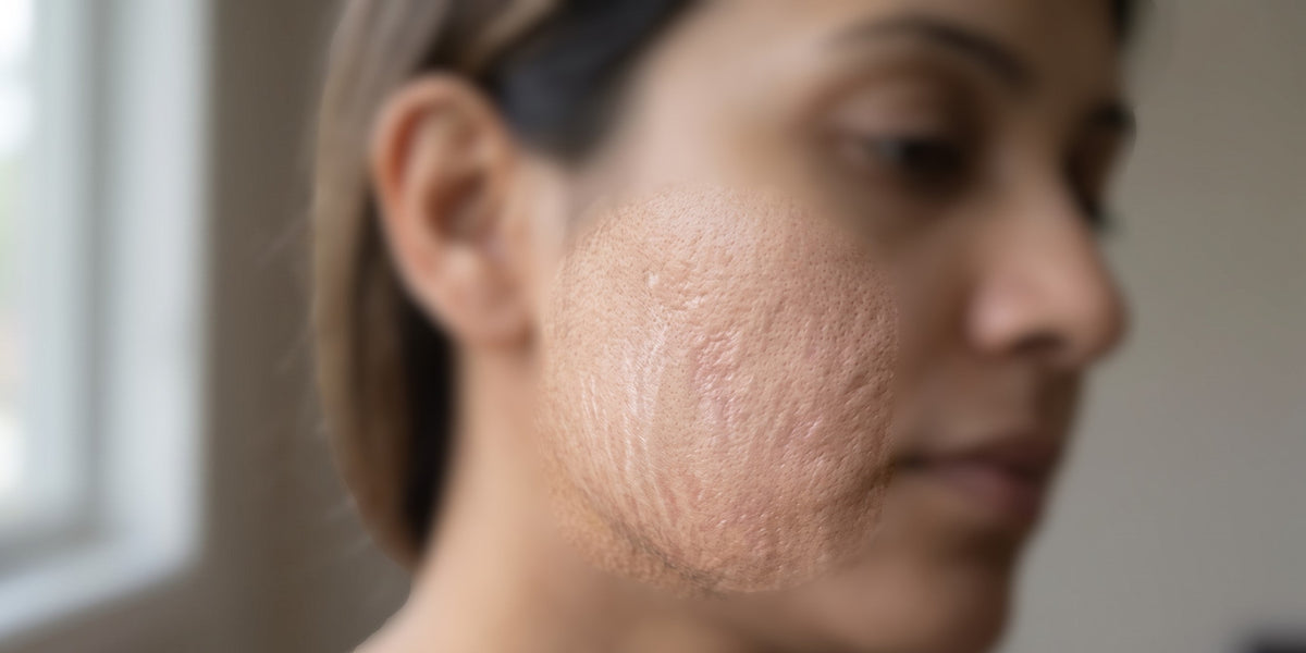 Understanding Stretch Marks