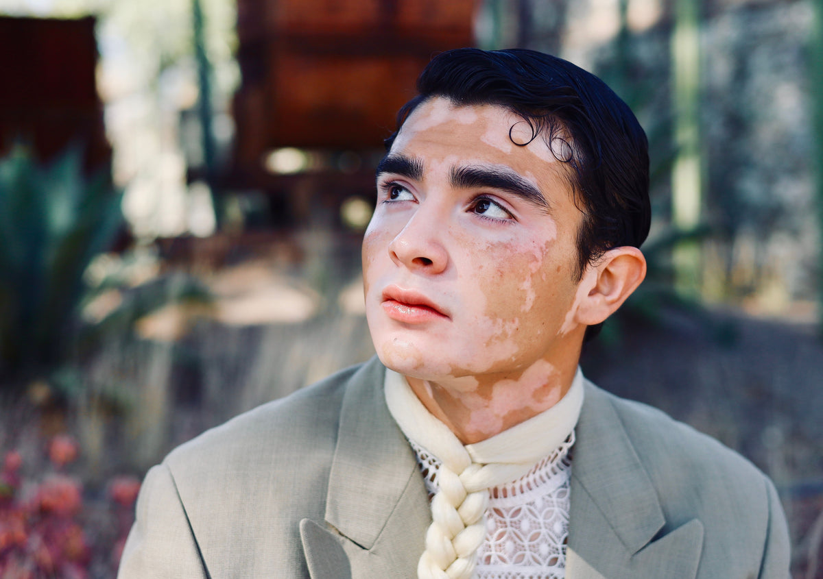 Fully clothed adult man with visible vitiligo patches on his face, photographed in natural light.