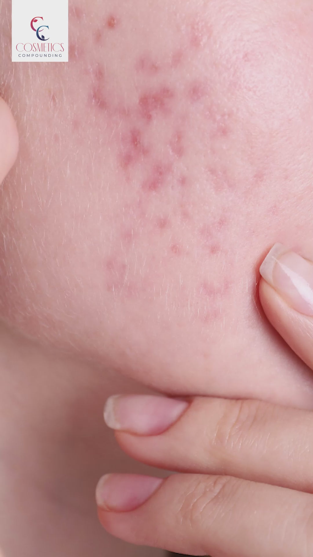 Azelaic Acid Cream