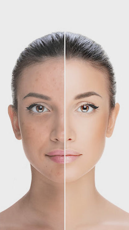 CC Anti Acne Cream for Pimples